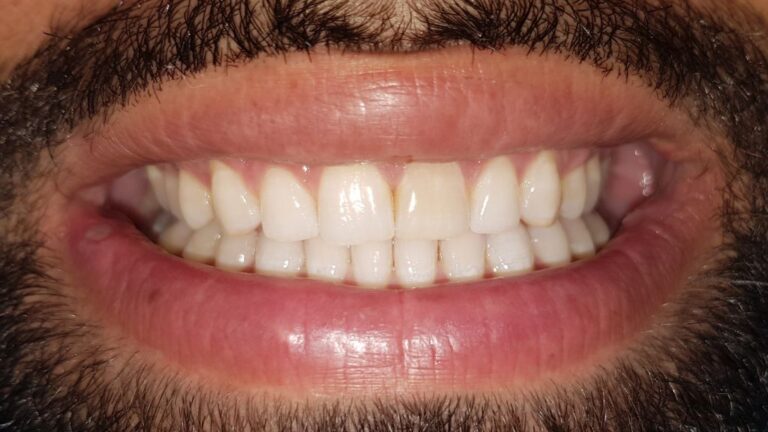 תמונה של פציינט אחרי יישור שיניים שקוף