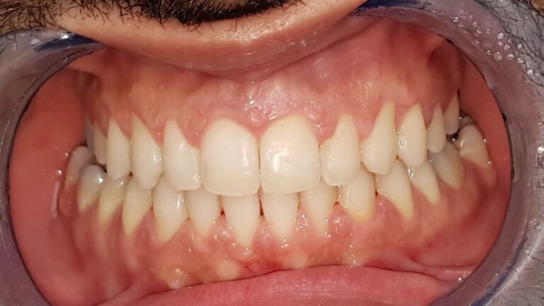 תמונה של פציינט אחרי יישור שיניים שקוף
